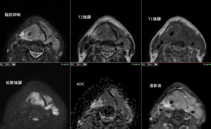 頸部MRI-下咽頭癌