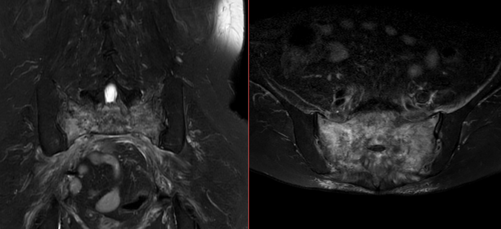 骨盤MRI-脆弱性骨折