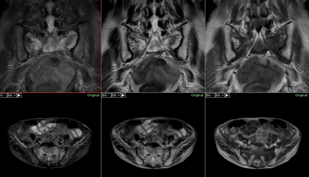骨盤MRI-仙骨脆弱性骨折