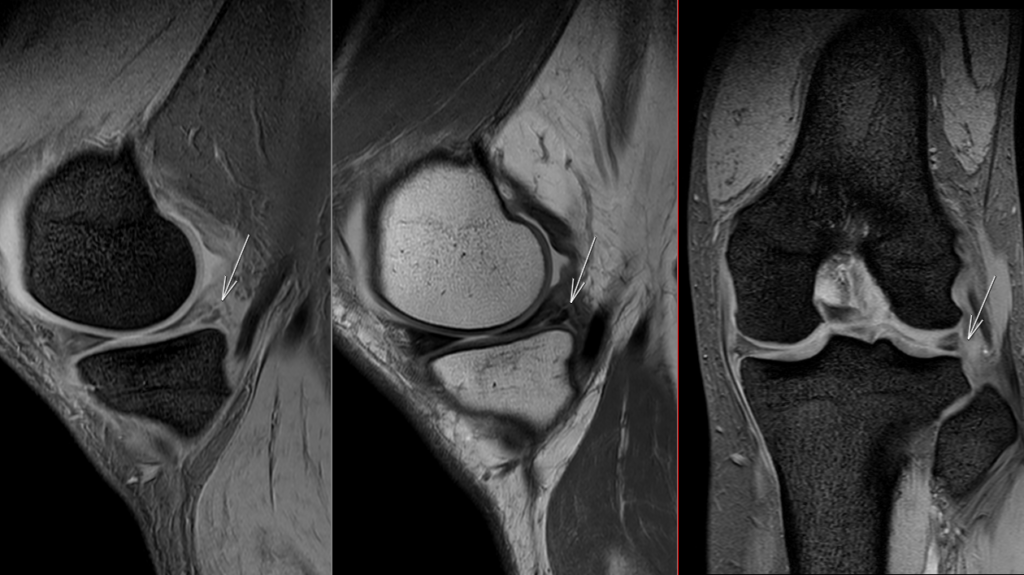 膝MRI-半月板損傷