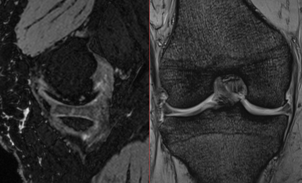 膝MRI-半月板断裂