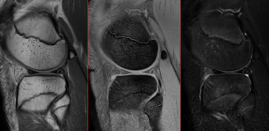 膝MRI-半月板損傷（全層断裂）