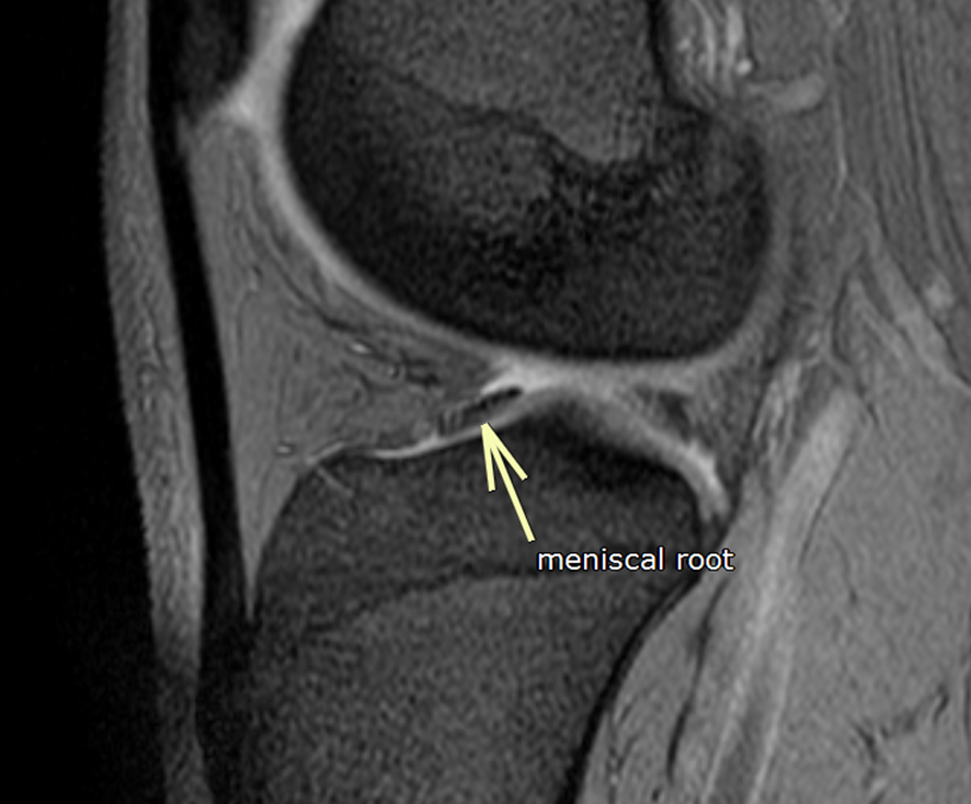 膝MRI-meniscal-root