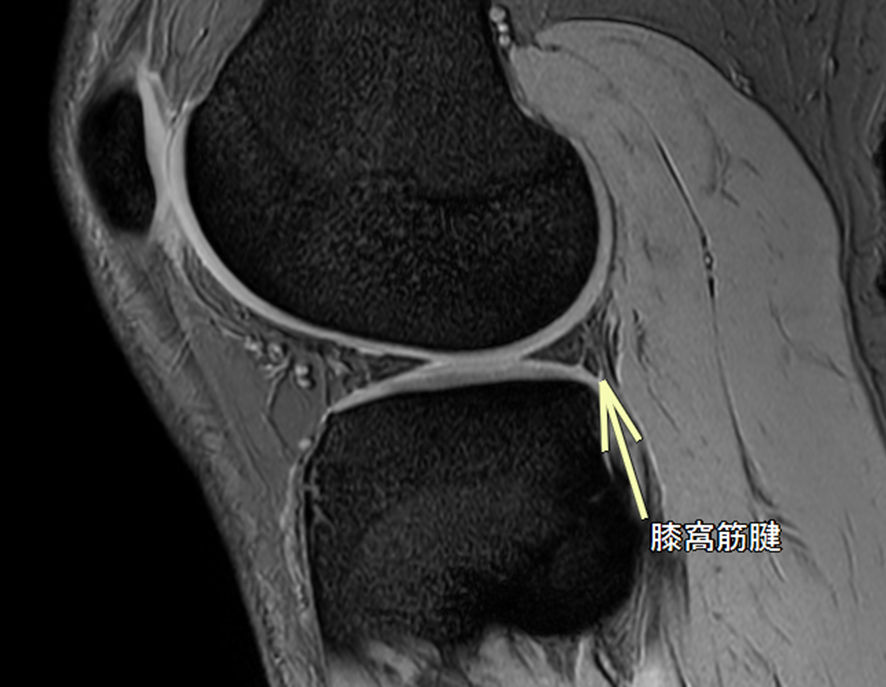 膝MRI-膝窩筋腱