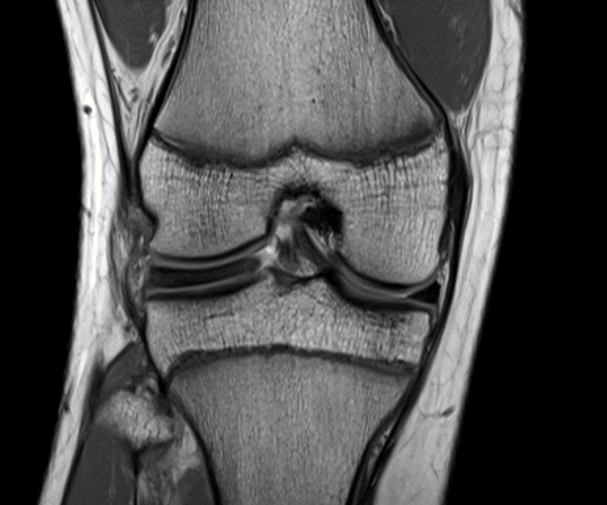膝MRI-円板状外側半月板
