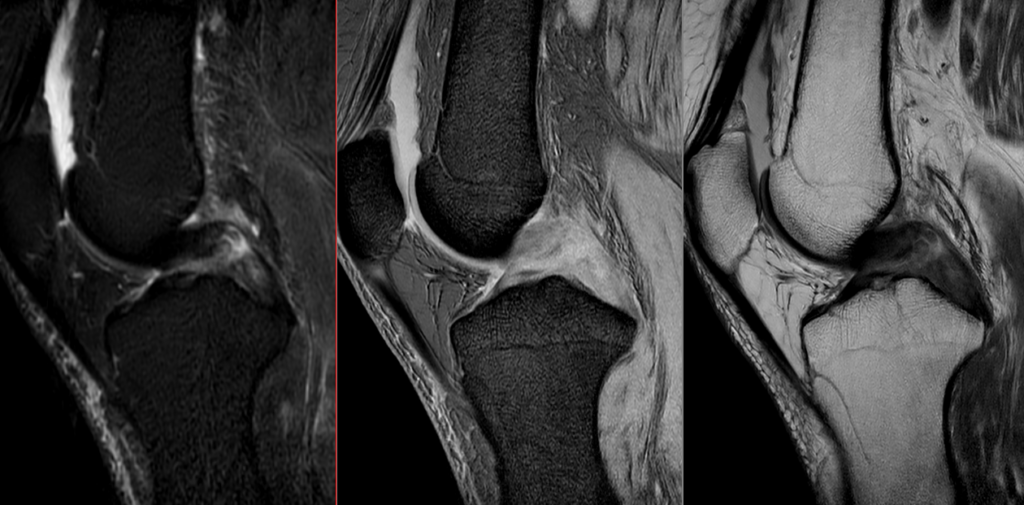 膝MRI-ACL断裂
