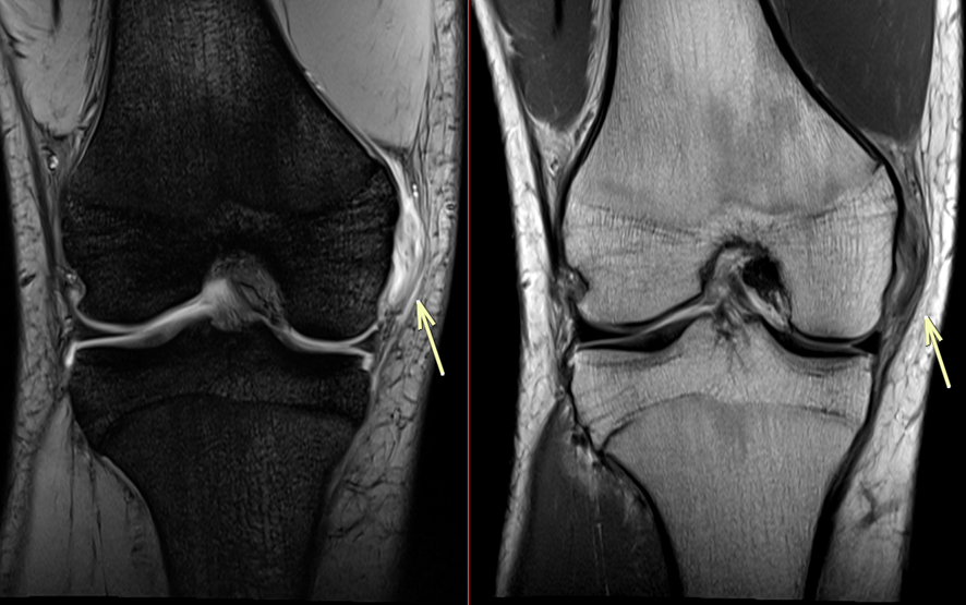 膝MRI-側副靱帯損傷