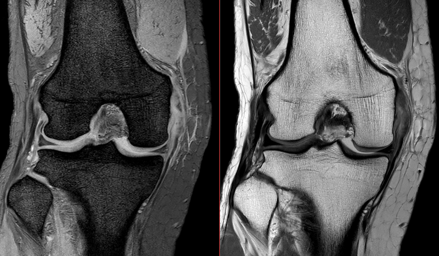 膝MRI-側副靱帯損傷（Grade3）