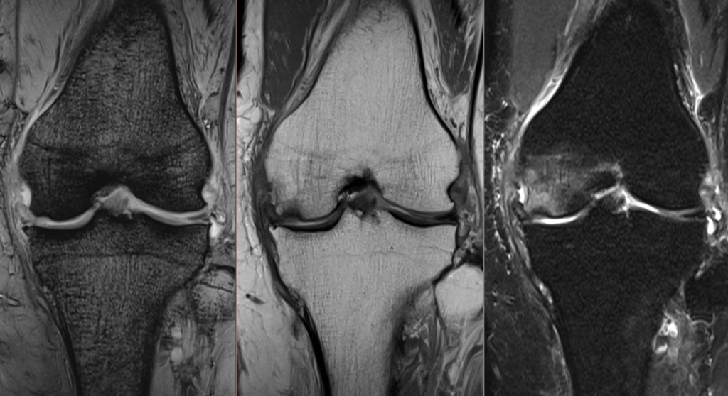 膝MRI-大腿骨内顆特発性骨壊死