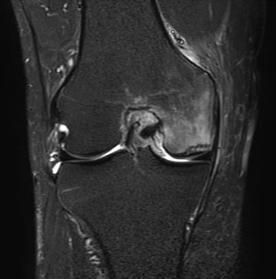 膝MRI-大腿骨内顆特発性骨壊死