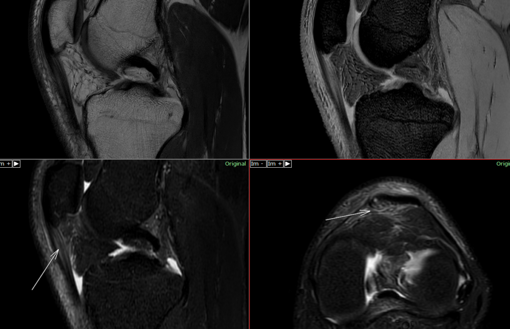 膝MRI-膝蓋靱帯損傷