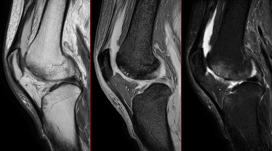 膝MRI-骨挫傷