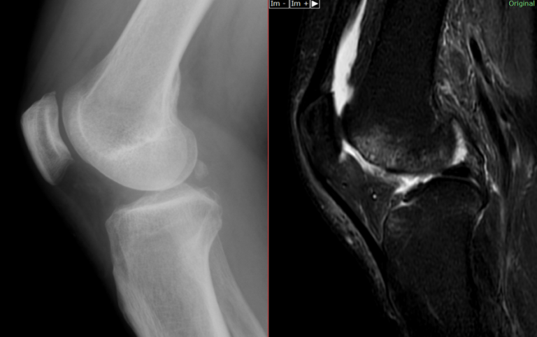 骨挫傷(bone bruise)
