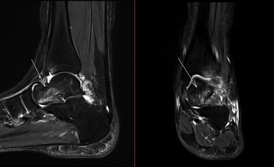 足関節MRI-骨挫傷