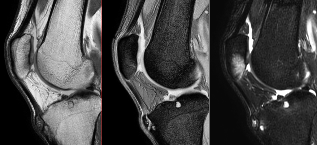 膝MRI-膝蓋骨骨挫傷