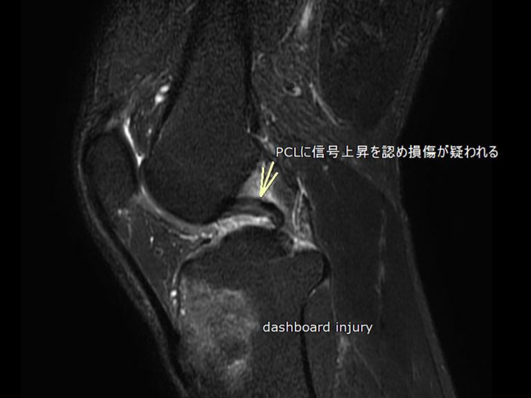 骨挫傷(bone bruise)