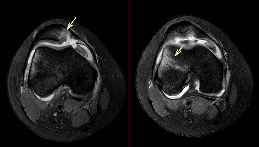 膝MRI-膝蓋骨脱臼