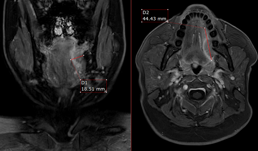 頸部MRI-舌癌