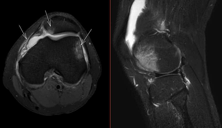 膝MRI-膝蓋骨脱臼