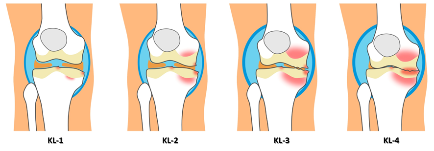 膝変形性関節症（KL分類）