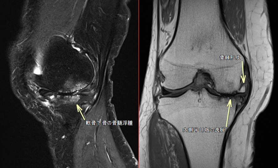 膝MRI-変形性膝関節症