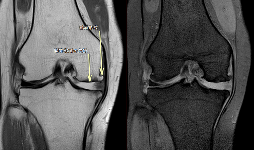 膝MRI-変形性膝関節症