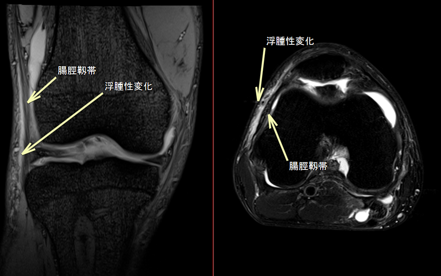 膝MRI-腸脛靱帯炎