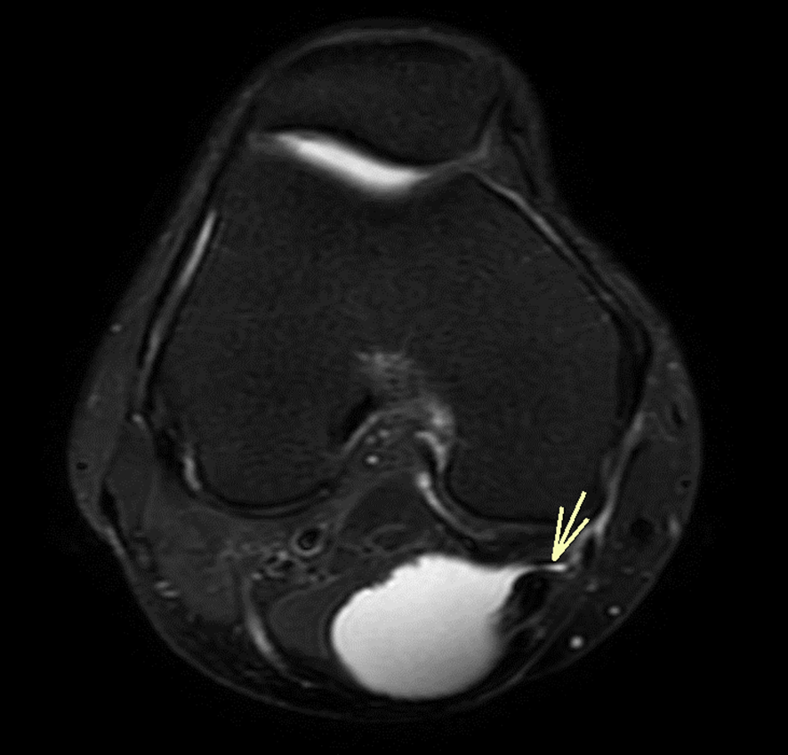 膝MRI-Baker嚢胞