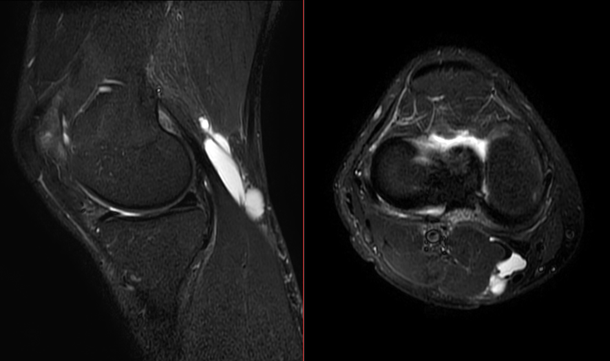 膝MRI-Baker嚢胞