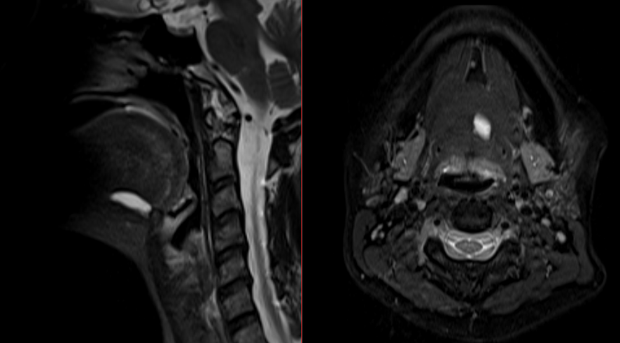 頸部MRI-ガマ腫
