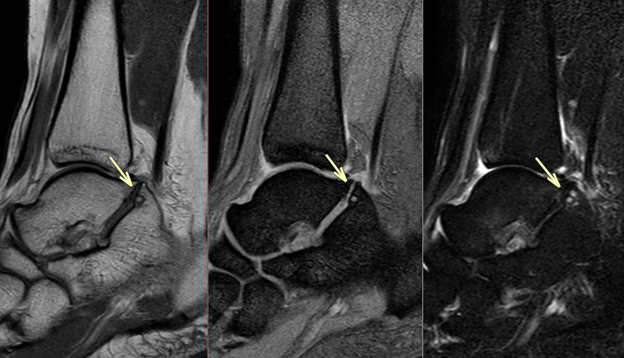 足MRI-距踵骨癒合症