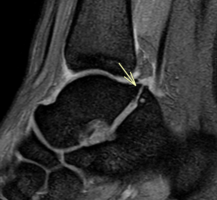 足MRI-距踵骨癒合症