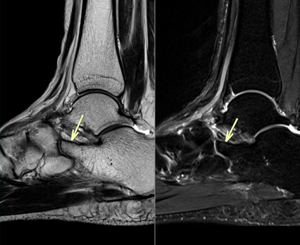 足MRI-踵舟状骨癒合症