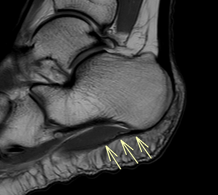 足底腱膜（MRI）