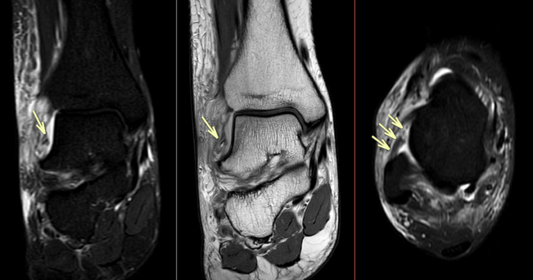 前距腓靱帯（anterior talofibular ligament：ATFL）損傷