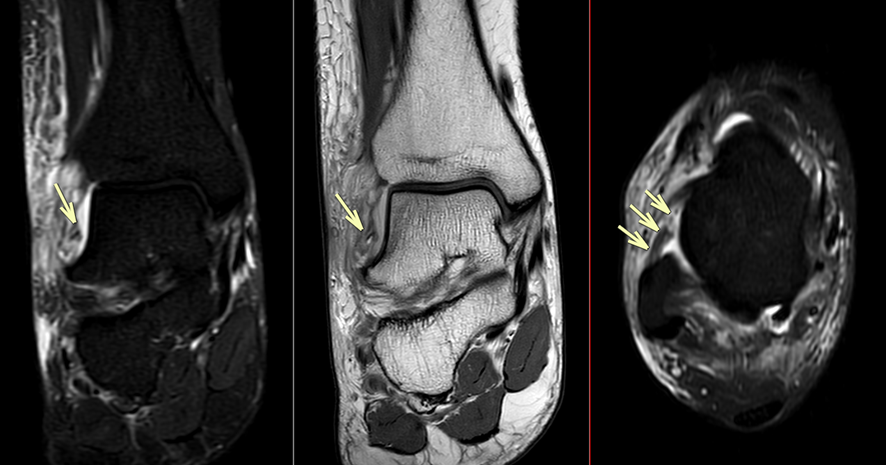 足関節MRI-前距腓靱帯損傷