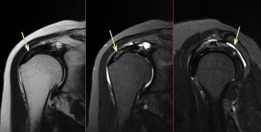 肩MRI-腱板損傷（内部分断列）