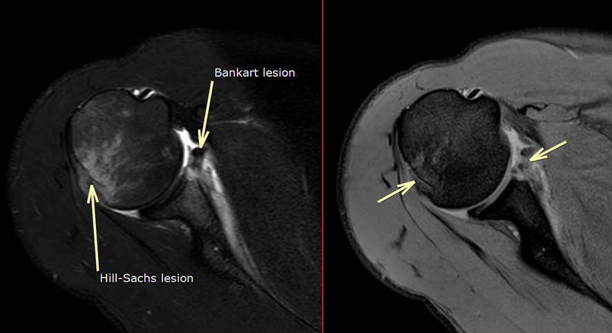 肩MRI-前方脱臼