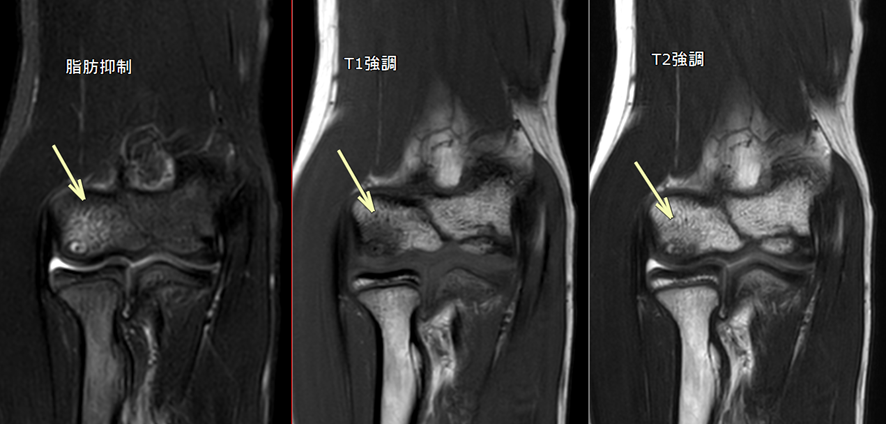肘MRI-離断性骨軟骨炎