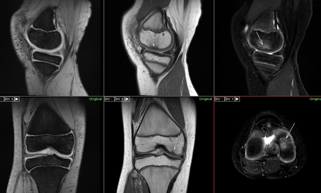 膝MRI-離断性骨軟骨炎