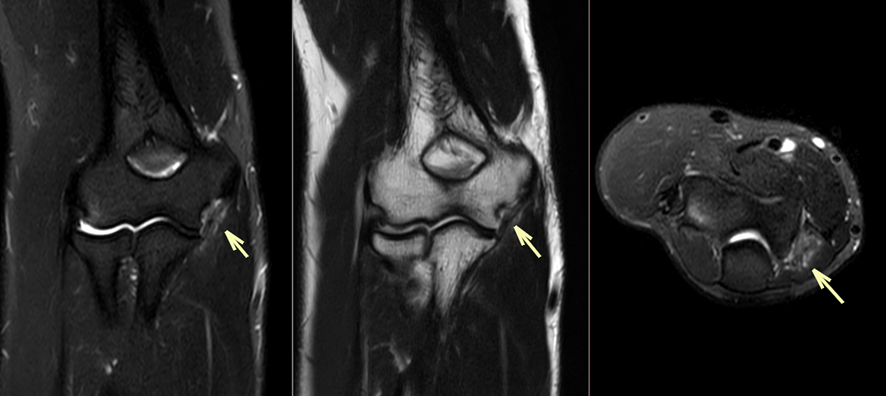 肘MRI-内側側副靱帯損傷