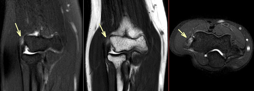 肘MRI-外側側副靱帯損傷