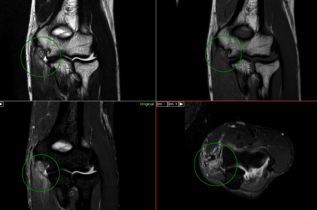 肘MRI-内側側副靱帯損傷2
