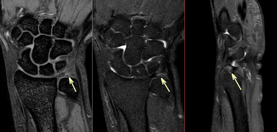 手関節MRI-TFC損傷