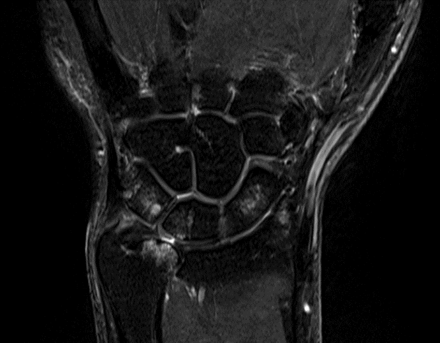 手関節MRI-尺骨突き上げ症候群