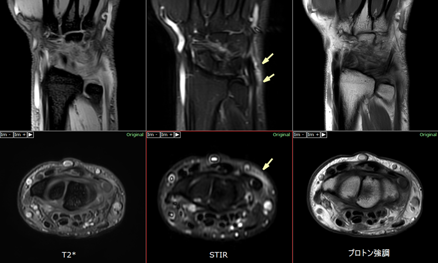 手関節MRI-尺側手根伸筋腱鞘炎