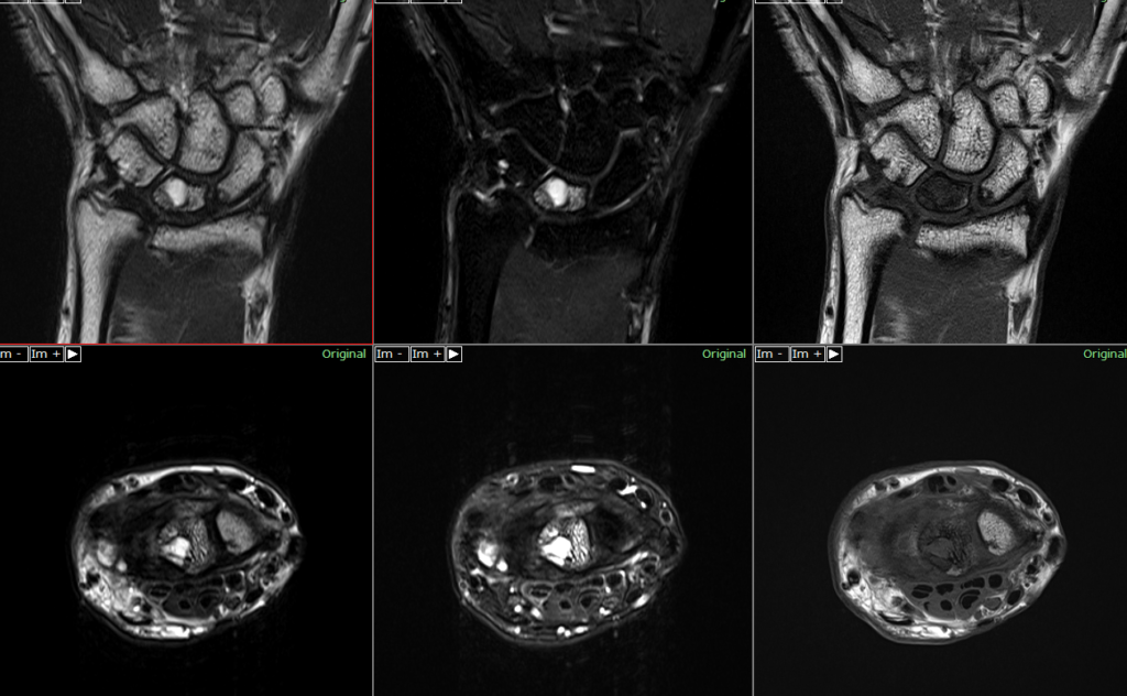 手関節MRI-キーンベック病（Stage2）