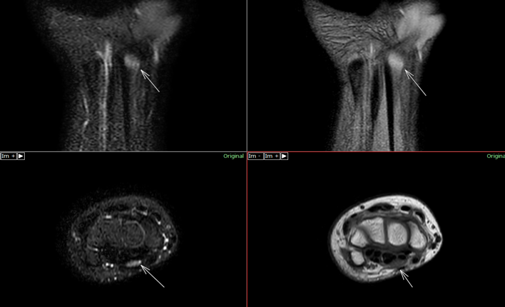 手MRI-手根管症候群2
