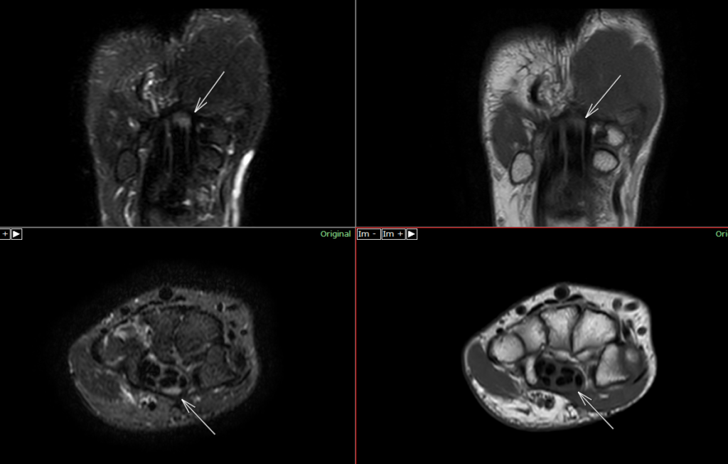 手MRI-手根管症候群3