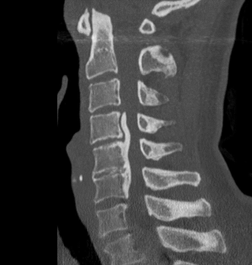 頚椎CT-後縦靱帯骨化症（連続型）
